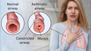 Asthma